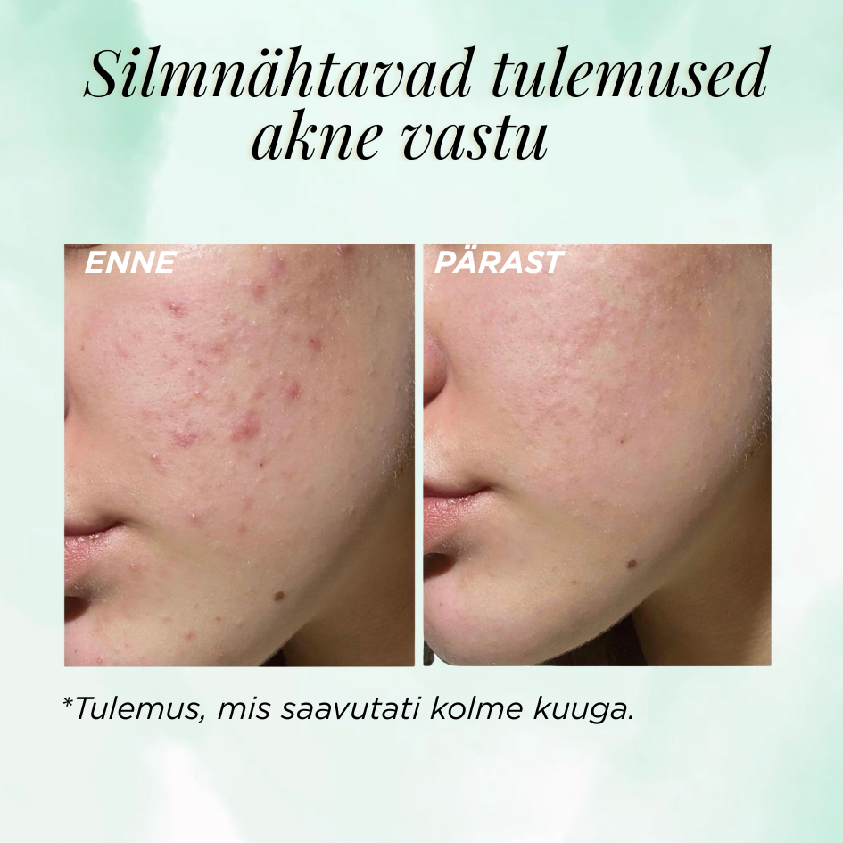 Anti-akne stardipakett probleemsele nahale - Image 3